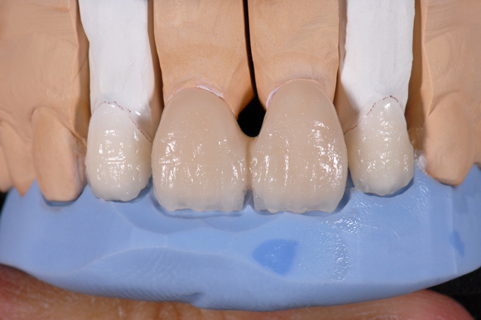 Ergebnis nach dem 1. Dentinbrand Ergebnis nach dem 1. Dentinbrand