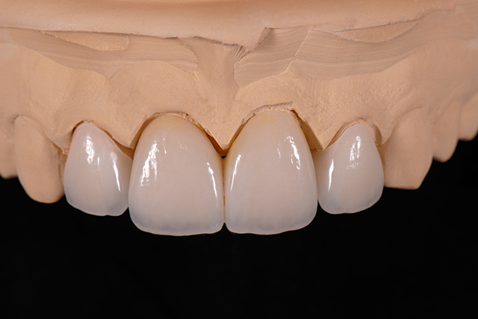Fertige Kronen und Veneers auf dem Modell. Fertige Kronen und Veneers auf dem Modell.