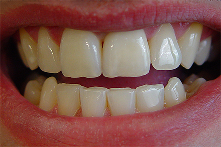 Step 5 completed crown