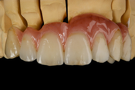 Frontzahnbr&uuml;cke labial