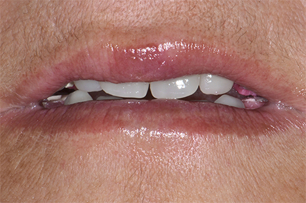 Step 6 ndividualization of the incisal area Step 6 ndividualization of the incisal area