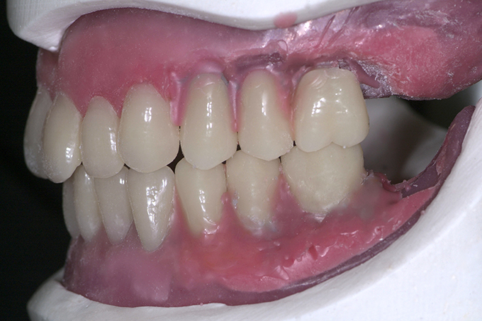 Step 7 The result prior to placement of the veneers. Step 7 The result prior to placement of the veneers.