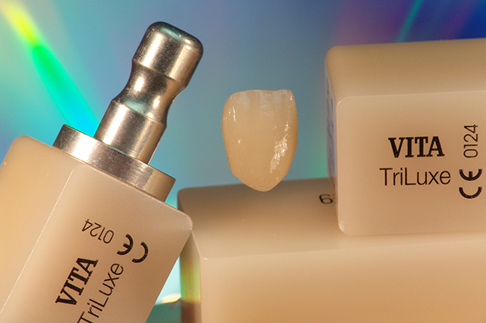 Die fertiggestellte Krone und VITABLOCS&reg; TriLuxe