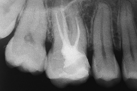 Initial xray Initial xray