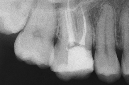 Initial xray Initial xray