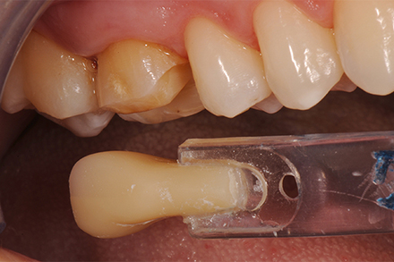 Shade selection Shade selection