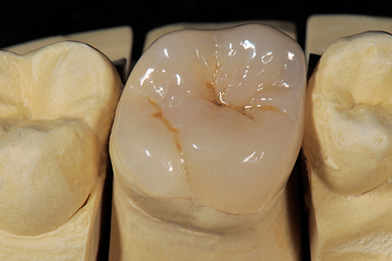 Shade selection Shade selection