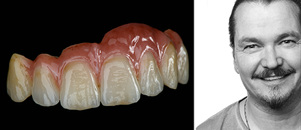 VITA Patientenfall von Björn Czappa VITA Patientenfall von Björn Czappa