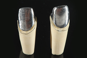 Patientenfall Marcio Breda: Metallkeramikger&uuml;ste