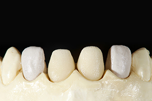 Patientenfall Marcio Breda: Veneers auf dem Meistermodell