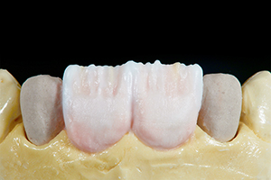 Patientenfall Marcio Breda: Mamelons