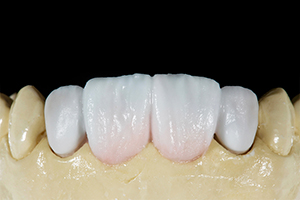 Patientenfall Marcio Breda: TRANSLUCENT Massen