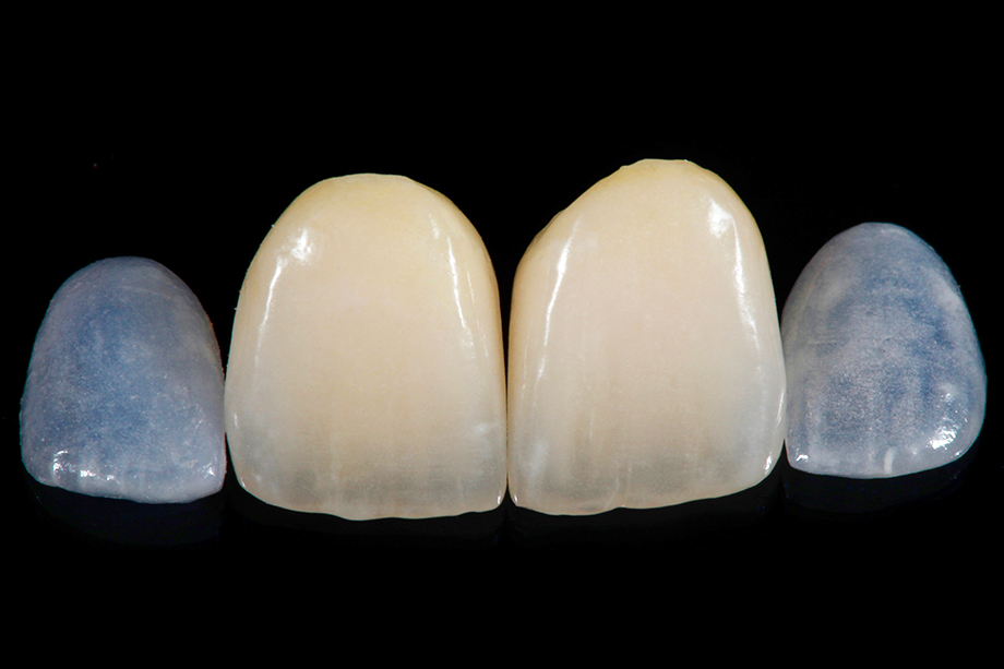 Patientenfall Marcio Breda: Fertigstellung der Kronen