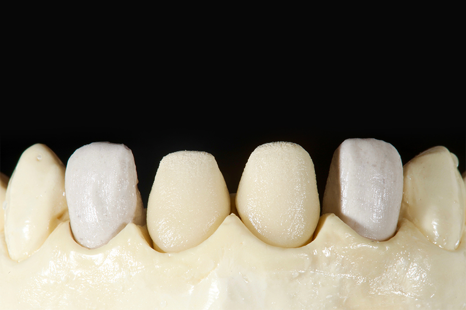 Patientenfall Marcio Breda: Veneers auf dem Meistermodell