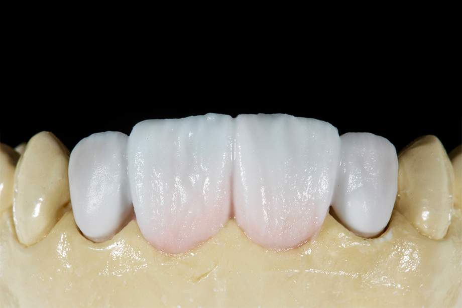 Patientenfall Marcio Breda: TRANSLUCENT Massen