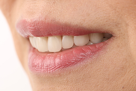 &Auml;sthetisch und funktional umgesetzt mit VITAPAN&reg; Frontz&auml;hnen und VITA LINGOFORM&reg; Seitenz&auml;hnen.