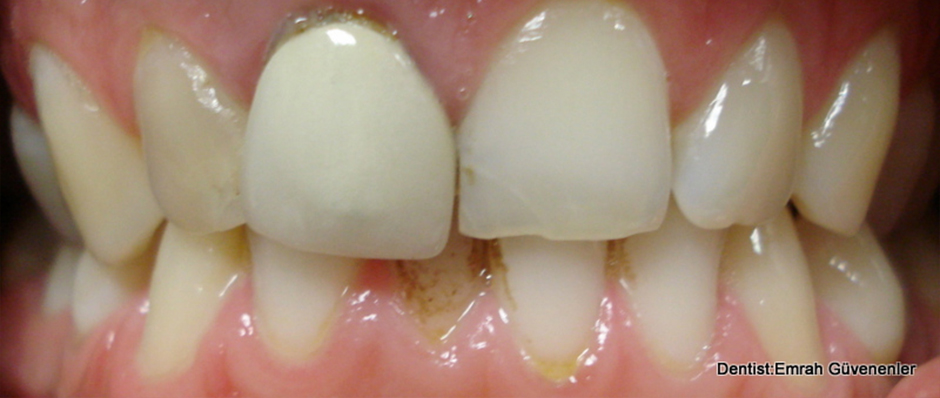 VITA Around The World. Halit Yağcı. Bursa, T&uuml;rkei. Fall 1: Frontzahnkrone