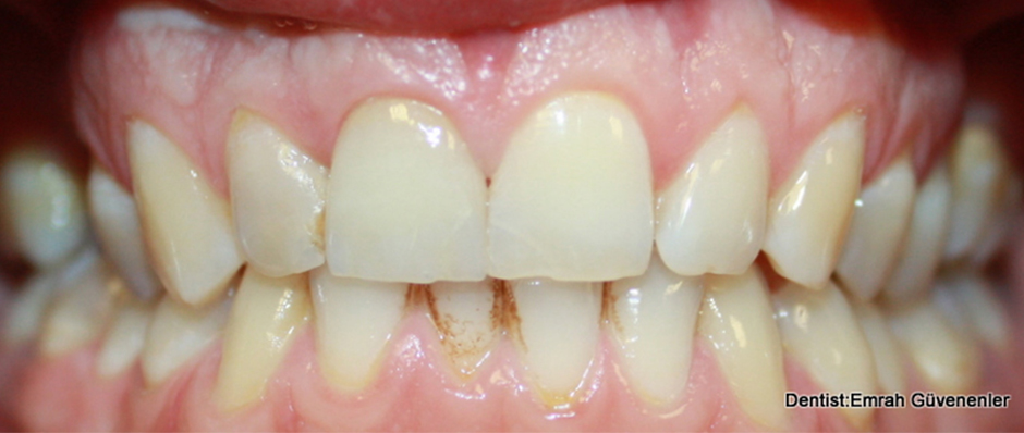 VITA Around The World. Halit Yağcı. Bursa, T&uuml;rkei. Fall 1: Frontzahnkrone