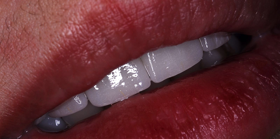 VITA Around The World. Halit Yağcı. Bursa, T&uuml;rkei. Fall 2: Veneers