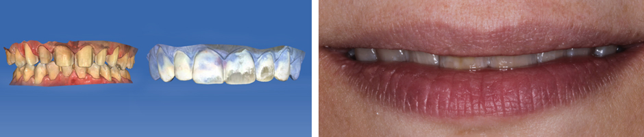 VITA Around The World. Halit Yağcı. Bursa, T&uuml;rkei. Fall 3: Frontzahnkronen