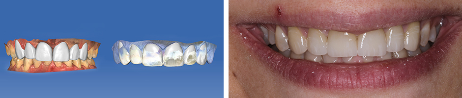 VITA Around The World. Halit Yağcı. Bursa, T&uuml;rkei. Fall 3: Frontzahnkronen