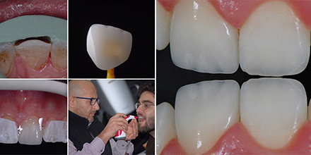 VITA Around The World. Halit Yağcı. Bursa, T&uuml;rkei. Fall 4: Einzelner Frontzahn