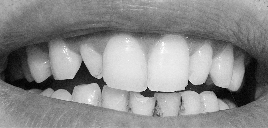 VITA Around The World. Halit Yağcı. Bursa, T&uuml;rkei. Fall 5: Veneers