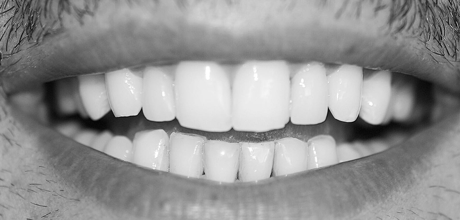 VITA Around The World. Halit Yağcı. Bursa, T&uuml;rkei. Fall 5: Veneers