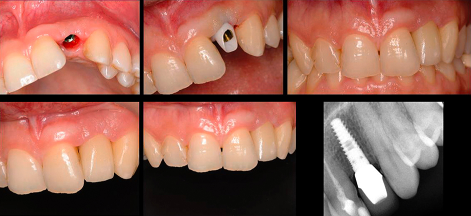 VITA Around The World. Halit Yağcı. Bursa, T&uuml;rkei. Fall 6: Implantat