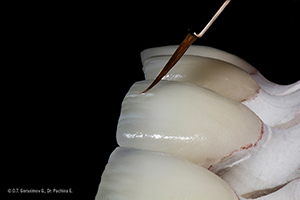 Caso cl&iacute;nico Georgy Gerasimov