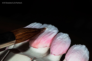 Caso cl&iacute;nico Georgy Gerasimov