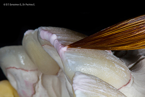 Caso cl&iacute;nico Georgy Gerasimov