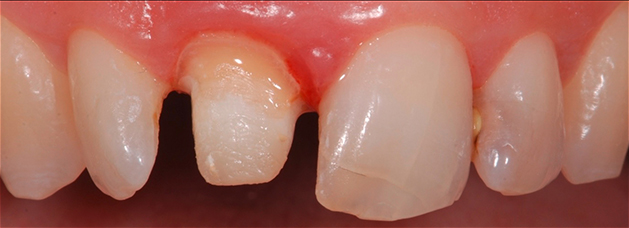 Beschliffener Zahn Beschliffener Zahn