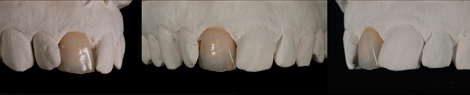 Die Restauration auf dem Modell. Die Restauration auf dem Modell.