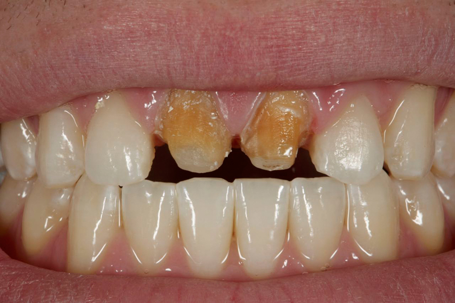 Caso cl&iacute;nico de Amos Harting EE.UU. Tras la preparaci&oacute;n.