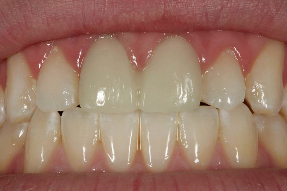 Caso cl&iacute;nico de Amos Harting EE.UU. PMMA