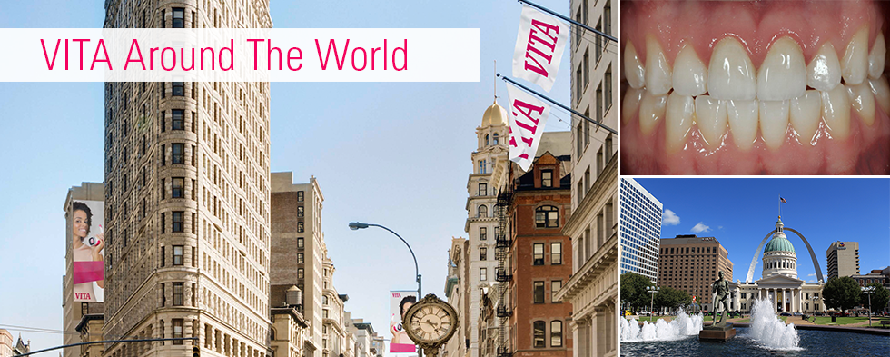 Caso cl&iacute;nico EE. UU. restauraci&oacute;n de dientes anteriores de Amos Harting. St. Louis (EE. UU.)