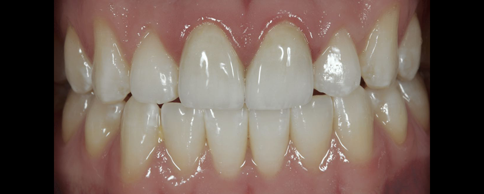 Caso cl&iacute;nico EE. UU. restauraci&oacute;n de dientes anteriores de Amos Harting. St. Louis (EE. UU.)