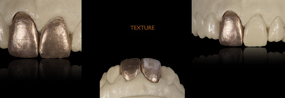 Patientenfall: Einzelne Frontzahnkrone aus VITAPM&reg;9. Francesco Ferretti . Rom, Italien.